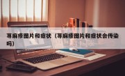 荨麻疹图片和症状（荨麻疹图片和症状会传染吗）